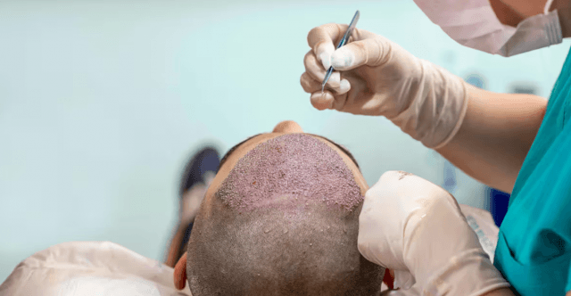 Hair Transplant in Turkey: Costs & Tips